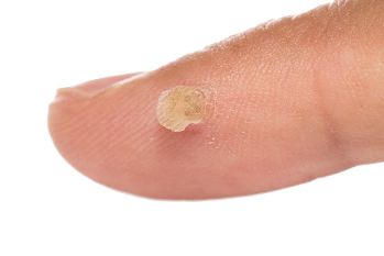 Sử dụng Skincell trong trường hợp đó, nếu bạn có những điểm da, nốt ruồi, mụn cóc, da liên quan đến tuổi thay đổi