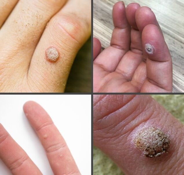 Các loại mụn cóc phổ biến trên ngón tay