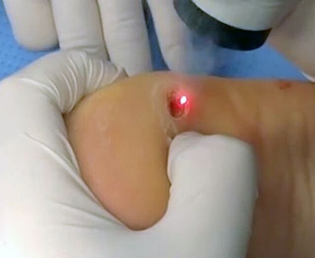Quy trình loại bỏ mụn cóc ở gót chân bằng tia laser