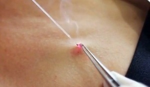 loại bỏ u nhú trên cơ thể bằng tia laser