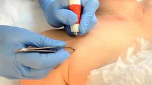 Electrocoagulation - một phương pháp để loại bỏ u nhú
